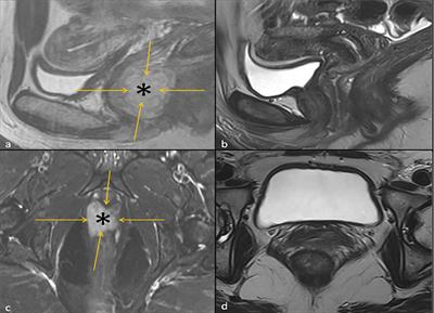 Case Report: Durable complete pathologic response and organ preservation following ipilimumab and nivolumab for locally advanced primary vaginal mucosal melanoma